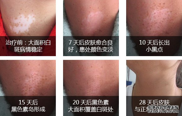 580母液细胞植补术治疗过程.jpg