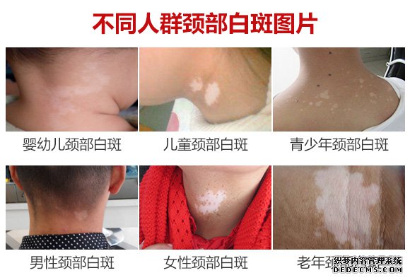 580不同人群颈部白斑2.jpg