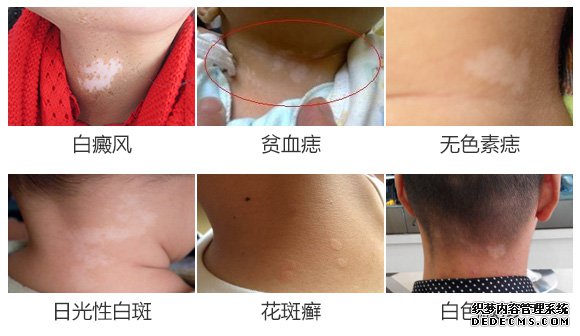 580白斑种类颈部.jpg