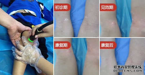 500308男孩腿部白斑图片案例.jpg