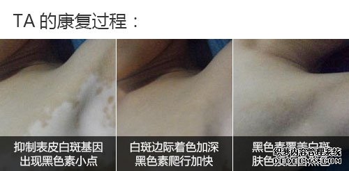 500案例腋TA的康复过程.jpg