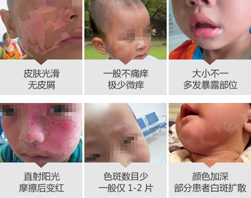 500儿童初期症状脸部.jpg