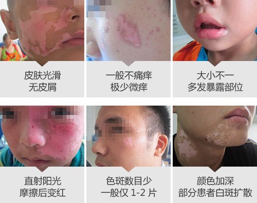 500初期症状脸部.jpg