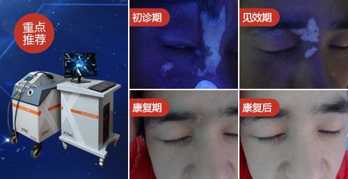 500青少年面部白斑图片案例.jpg