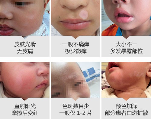 500儿童脸部早期症状.jpg