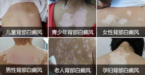 500不同人群背部白癜风.jpg