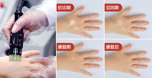 500正在治疗男孩手部图片案例.jpg