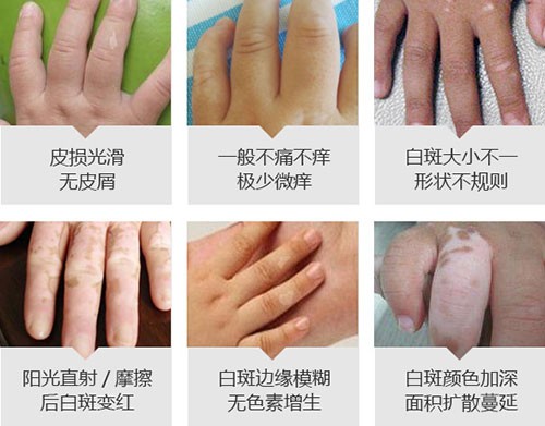 580儿童手指白斑症状.jpg
