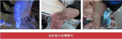 兰州中医第八届白癜风复色案例分享