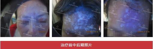 兰州中医第八届白癜风复色案例分享