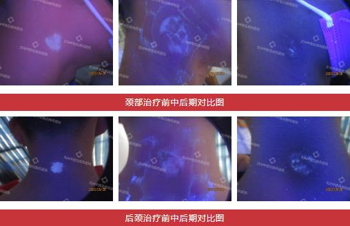 兰州中医第八届白癜风复色案例分享