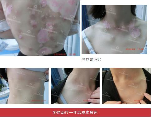 兰州中医第八届白癜风复色案例分享