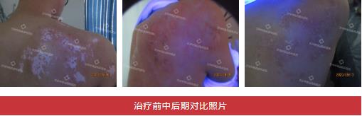兰州中医第八届白癜风复色案例分享