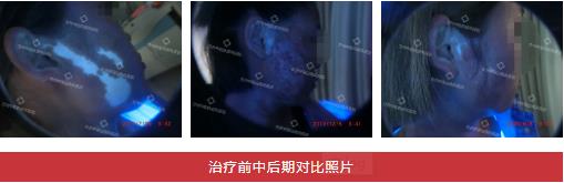 兰州中医第八届白癜风复色案例分享