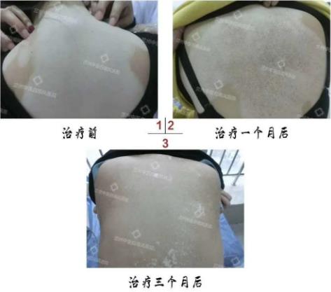 兰州中医第八届白癜风复色案例分享
