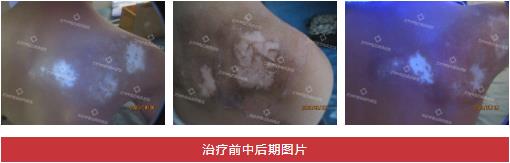 兰州中医第八届白癜风复色案例分享