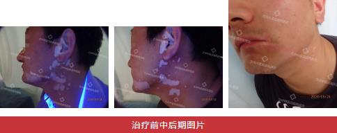 兰州中医第八届白癜风复色案例分享