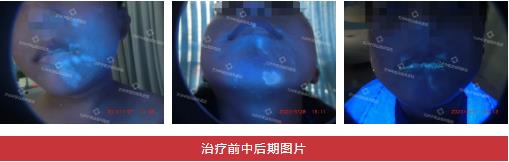兰州中医第八届白癜风复色案例分享