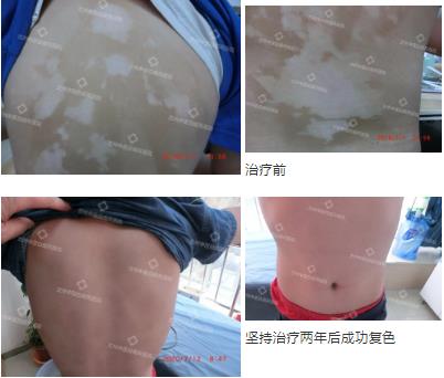 兰州中医第八届白癜风复色案例分享