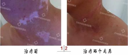兰州中医第八届白癜风复色案例分享