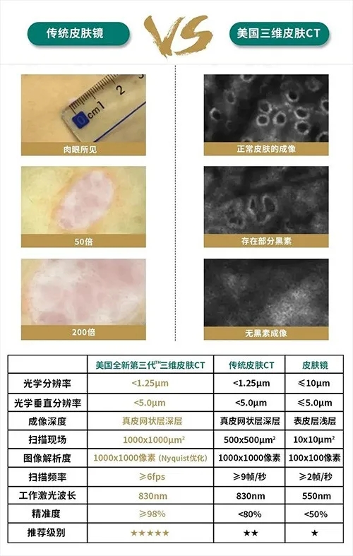 兰州中医白癜风医院美国三维皮肤CT(VS)传统皮肤镜!
