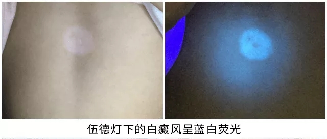 兰州中医白癜风医院美国三维皮肤CT(VS)传统皮肤镜!